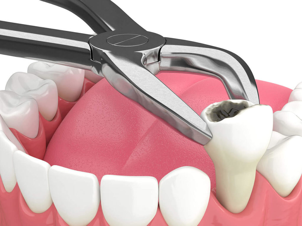 Image of tooth extraction procedure.
