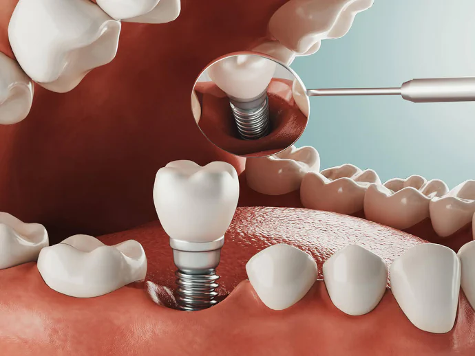 Dental implants at Willow Dental in Berlin, WI.