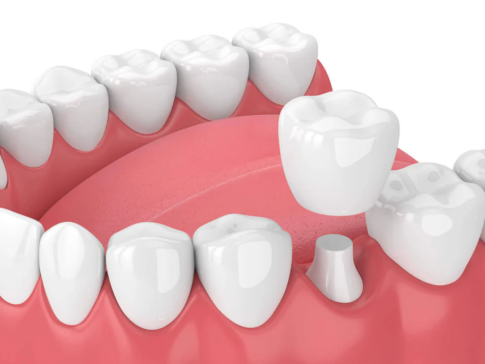 Dental crowns and bridges at Willow Dental in Berlin, WI.
