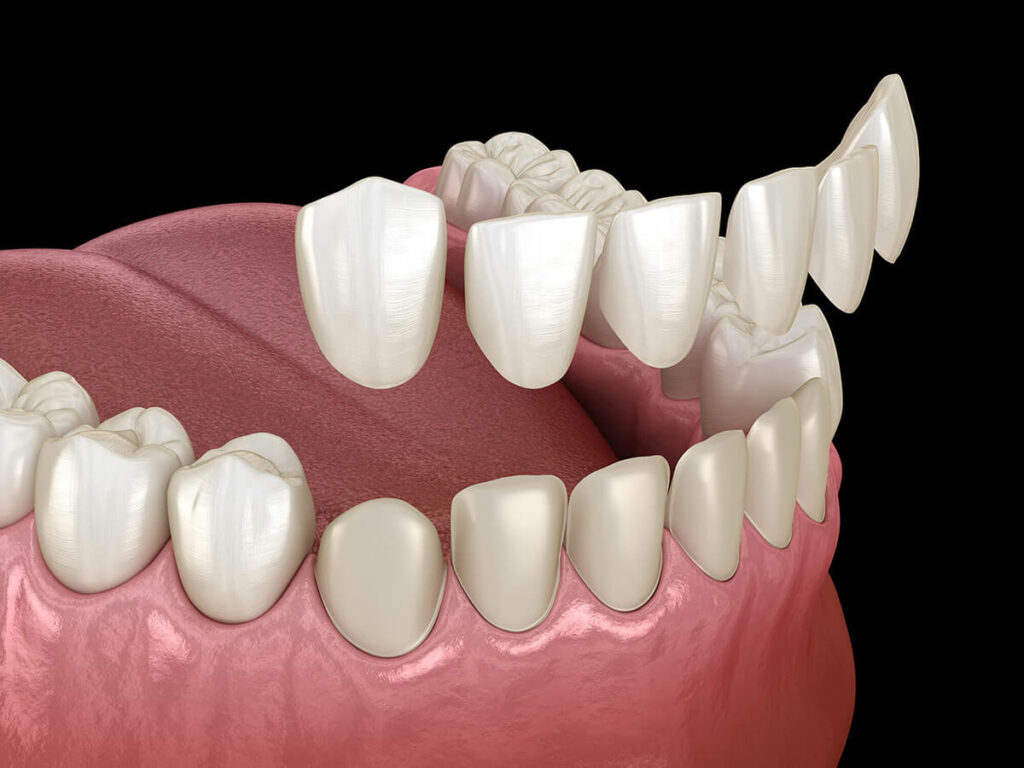 Model of dental veneers being placed