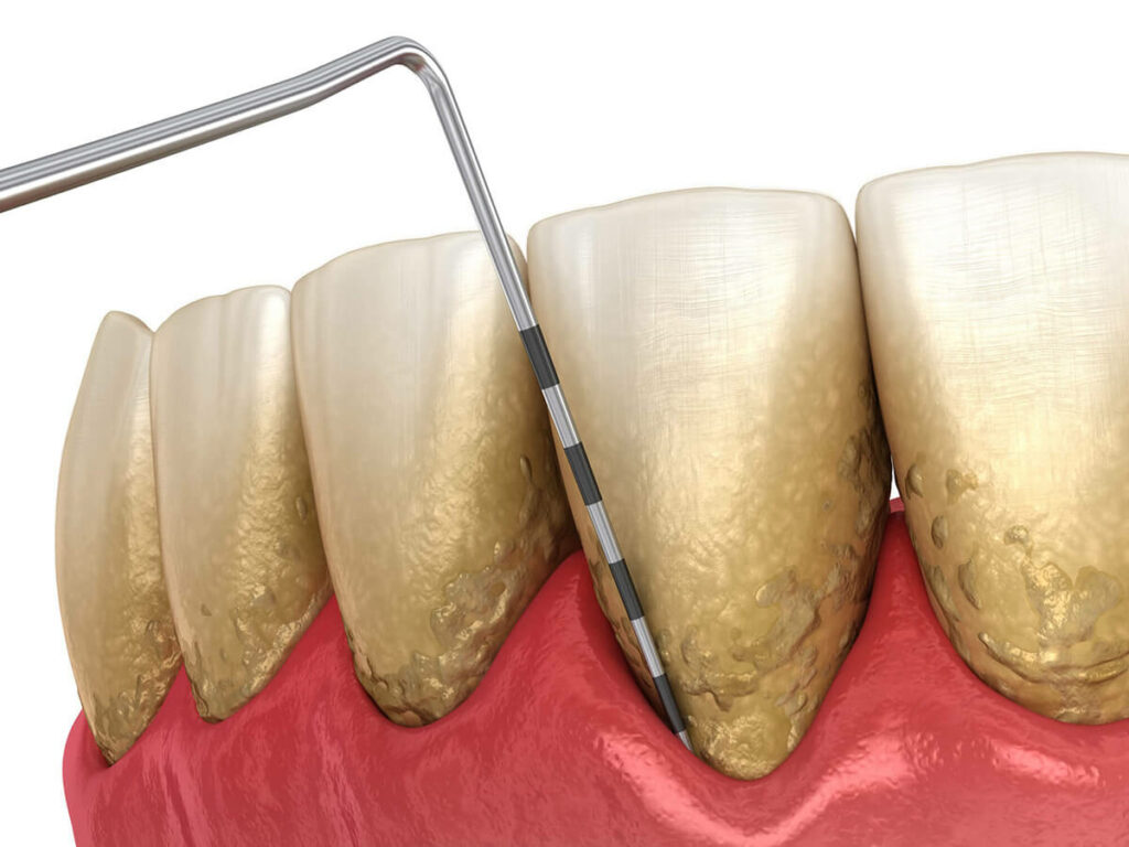 Close-up of a person receiving a dental scaling.