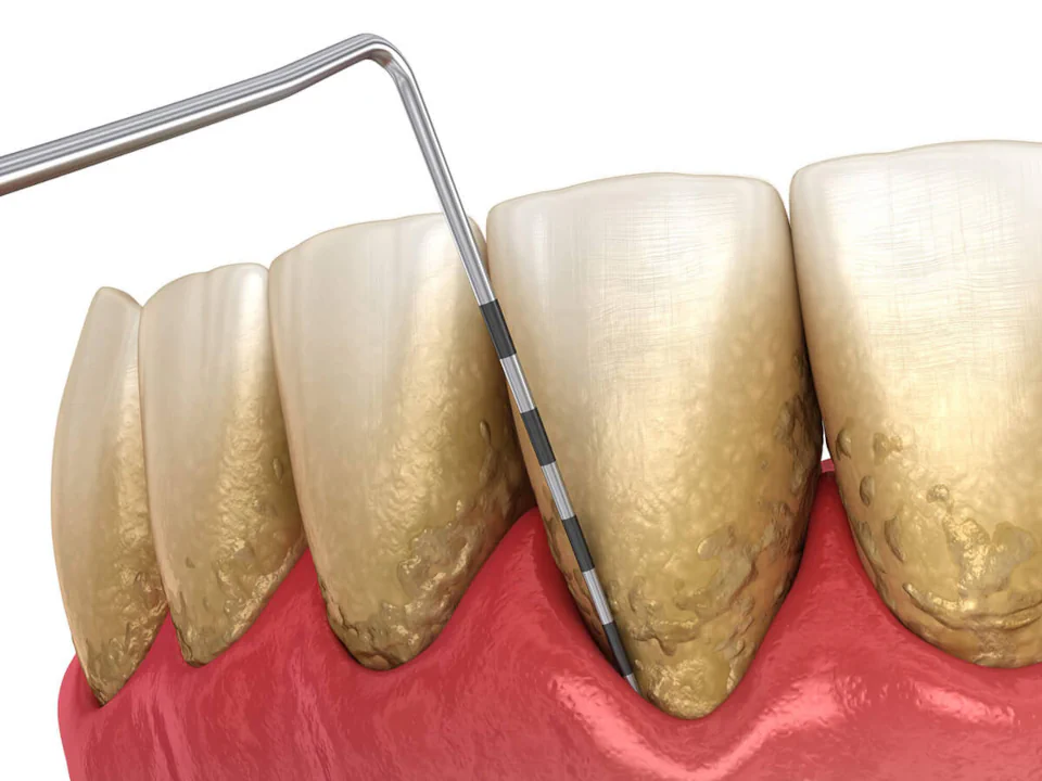 Gum disease treatment at Willow Dental in Berlin, WI.