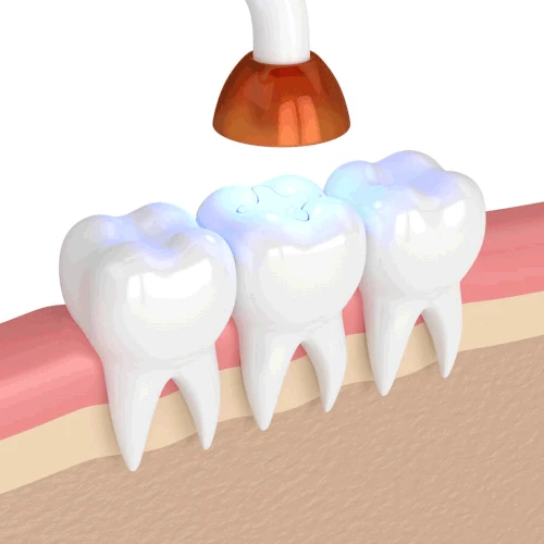 Cavity fillings and dental sealants at Willow Dental in Berlin, WI.