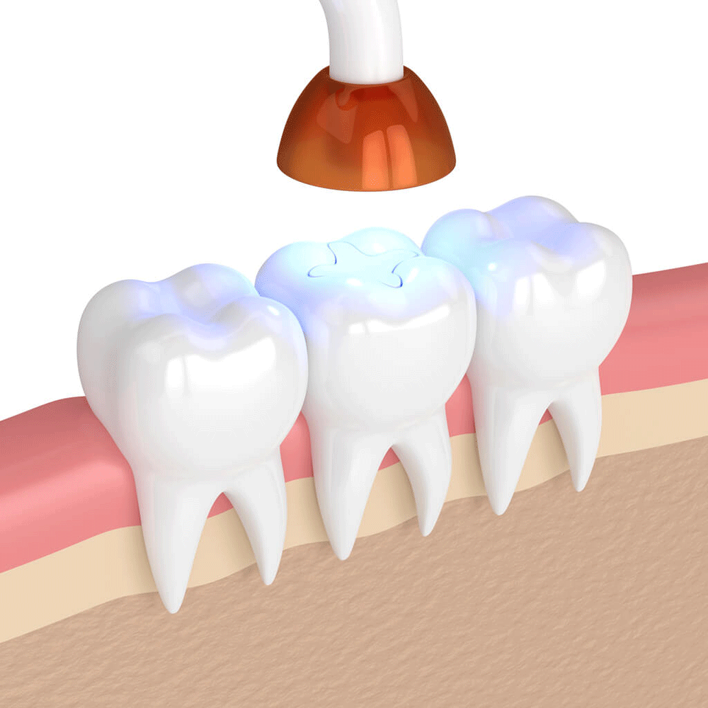 Model of three teeth and one tooth with a filling