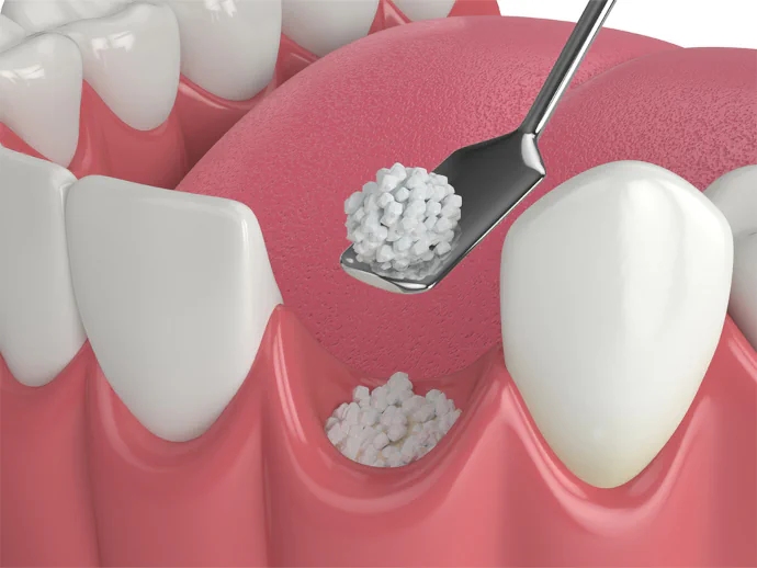 Dental bone grafting at Willow Dental in Berlin, WI.