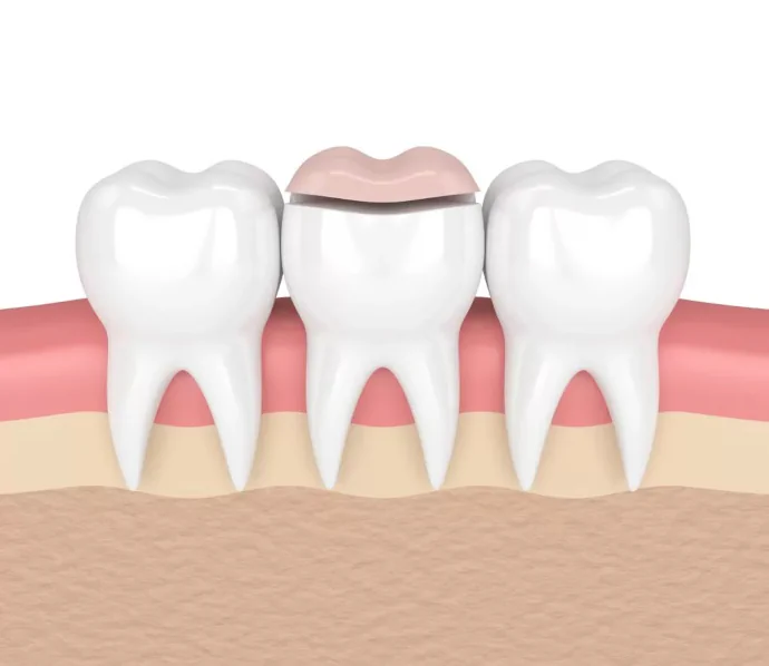Dental inlays and onlays at Willow Dental in Berlin, WI.