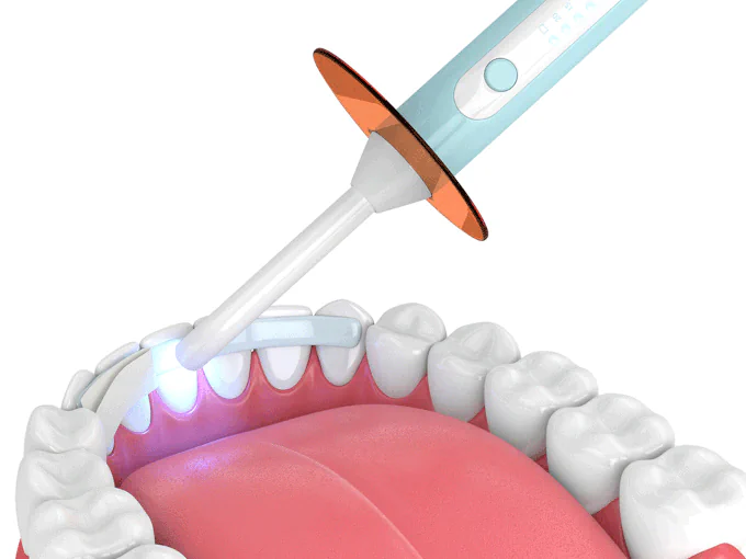 Dental bonding at Willow Dental in Berlin, WI.