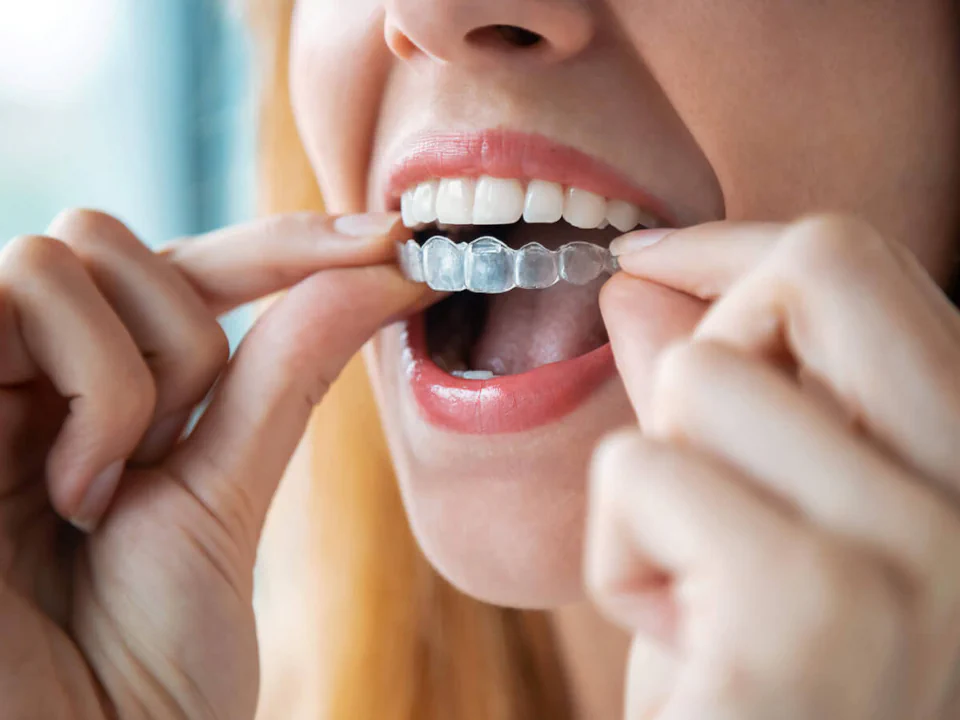 Invisalign clear aligners at Willow Dental in Berlin, WI.