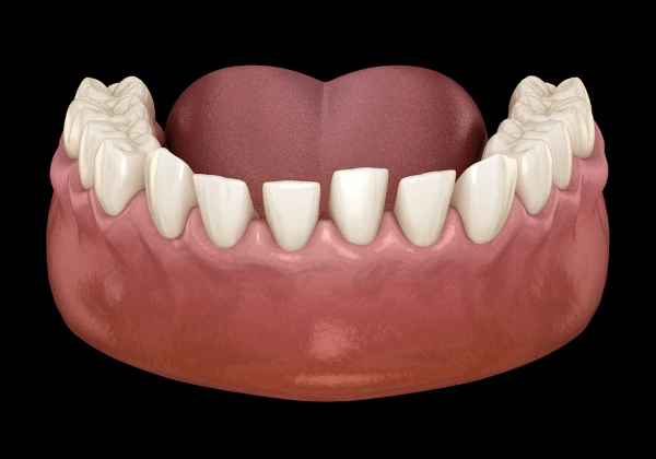 Teeth spacing correction at Willow Dental in Berlin, WI.