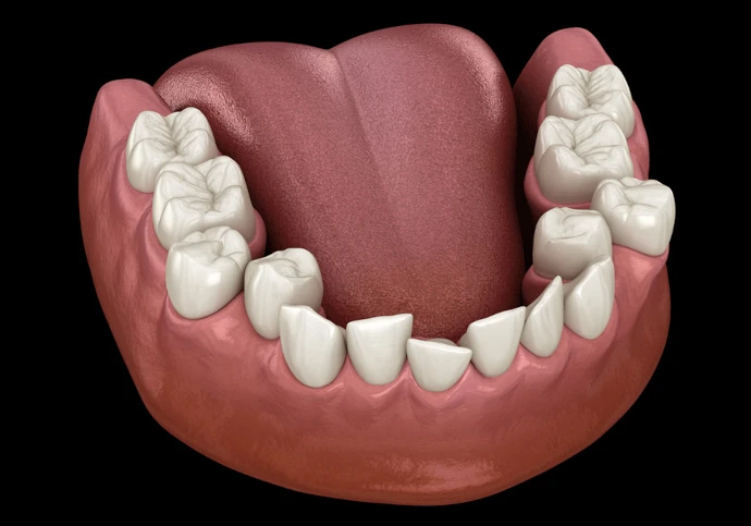 Tooth crowding correction at Willow Dental in Berlin, WI.