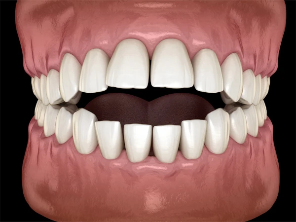 Open bite correction at Willow Dental in Berlin, WI.