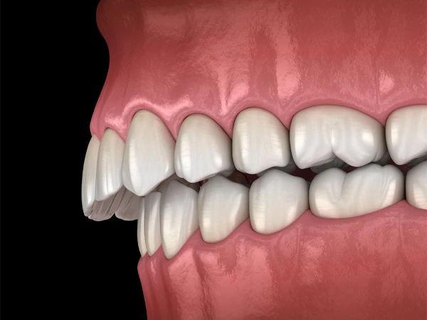Overbite Correction at Willow Dental in Berlin, WI.