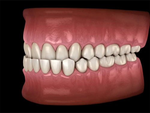 Underbite correction at Willow Dental in Berlin, WI.