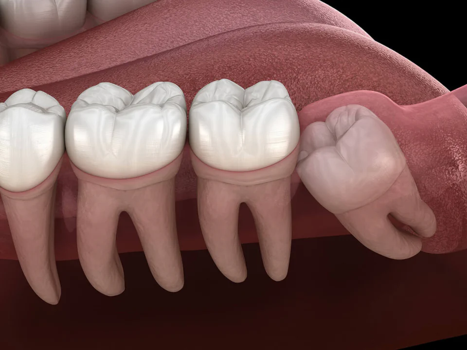 Wisdom tooth removal at Willow Dental in Berlin, WI.