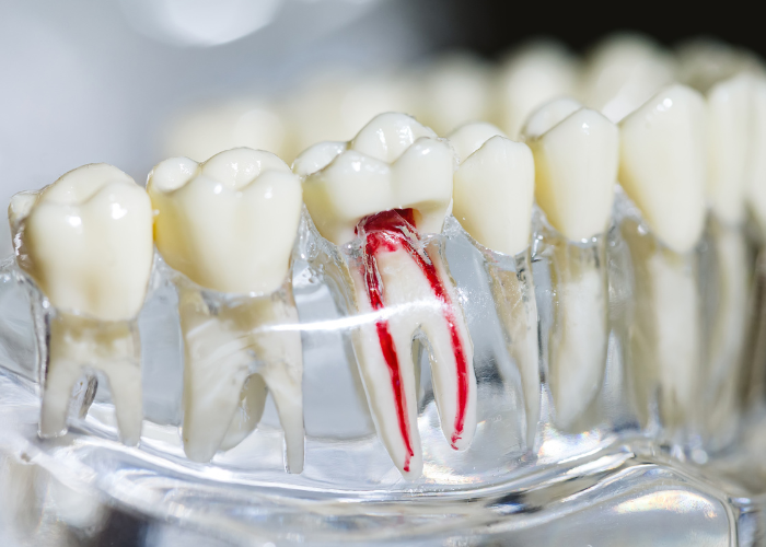 Close-up image of a root canal